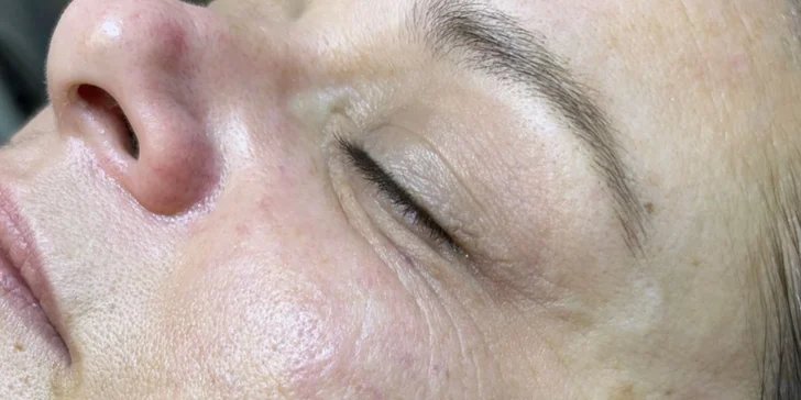 HIFU terapia - neinvazívny lifting pleti v Anzu Cosmetics