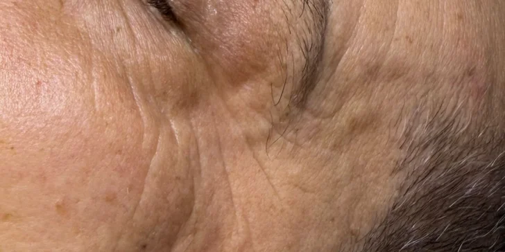 HIFU terapia - neinvazívny lifting pleti v Anzu Cosmetics