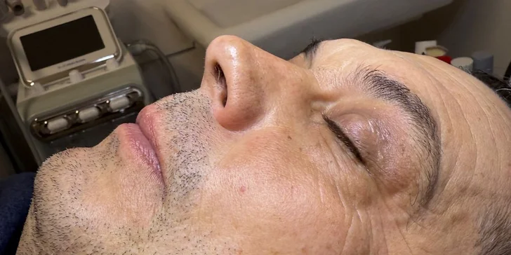 HIFU terapia - neinvazívny lifting pleti v Anzu Cosmetics