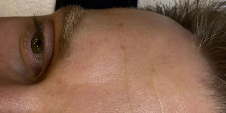HIFU terapia - neinvazívny lifting pleti v Anzu Cosmetics