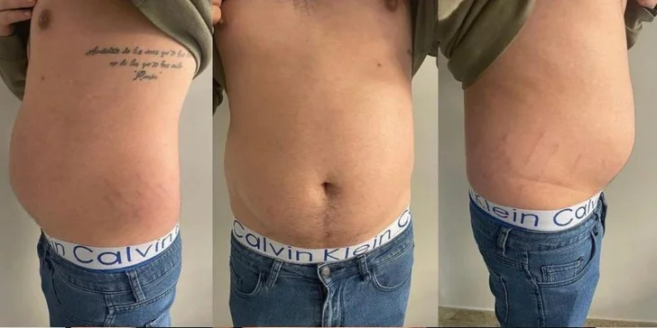 Neinvazívna liposukcia ultrazvukom Liposonix AVA .I.