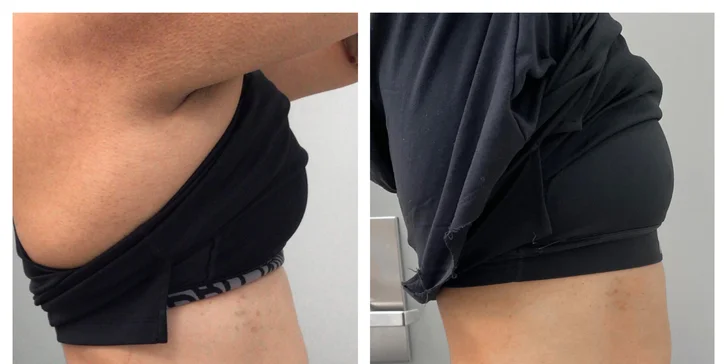 Neinvazívna liposukcia ultrazvukom Liposonix AVA .I.