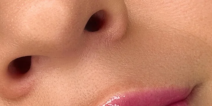 Výplň pier kyselinou hyalurónovou alebo hĺbkovo hydratačný "Lip Booster"