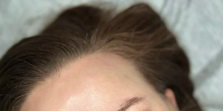 Výplň pier kyselinou hyalurónovou alebo hĺbkovo hydratačný "Lip Booster"