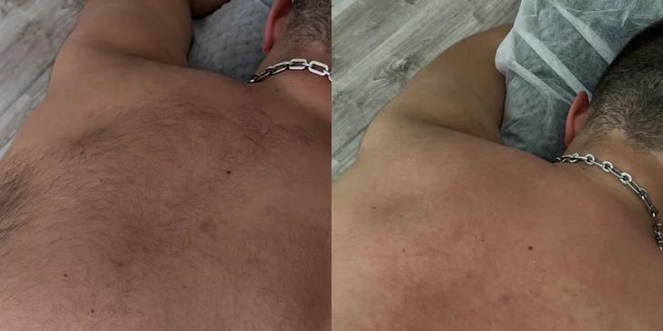 Depilácia voskom rôznych oblastí: Horná pera, nohy, predlaktia, bikini, chrbát a i.