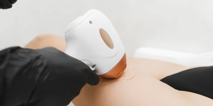 Laserová epilácia rôznych oblastí pre dámy