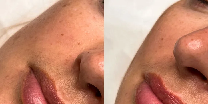 Pleťové ošetrenia v Lovely Beauty by LUNA: BB Glow, skinscrubber a diamantová mikrodermabrázia