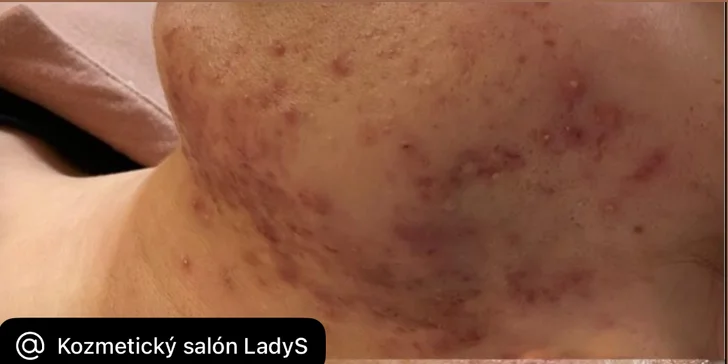 Dermabrázia, chemický peeling alebo antiakné ošetrenie s LED terapiou