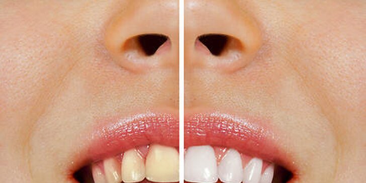 Šetrné bielenie zubov bez peroxidu