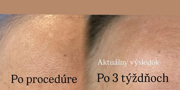 Čistenie pleti s chemickým peelingom, mezoterapia či plazmalifting