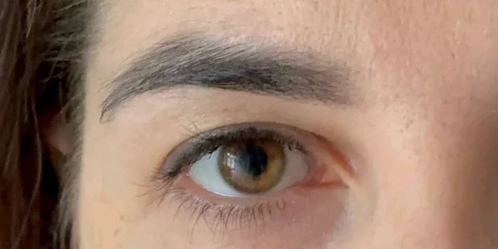 Čistenie pleti s chemickým peelingom, mezoterapia či plazmalifting