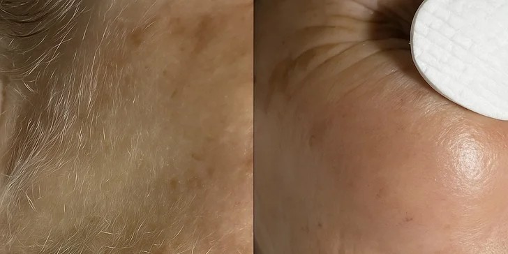 Kozmetické ošetrenia: dermaplaning pre hladkú a sviežu pleť a mezoterapia