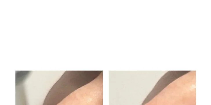 Kyselina hyalurónová: Zväčšenie pier, výplň vrások, tekutý lifting či rhinoplastika