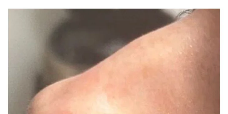 Kyselina hyalurónová: Zväčšenie pier, výplň vrások, tekutý lifting či rhinoplastika