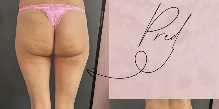 Vákuová terapia tela alebo tváre: spevnenie pleti aj zoštíhlenie a boj proti celulitíde