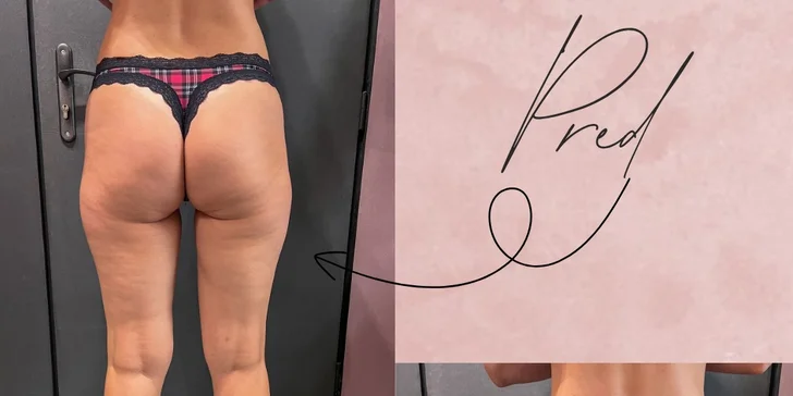 Vákuová terapia tela alebo tváre: spevnenie pleti aj zoštíhlenie a boj proti celulitíde