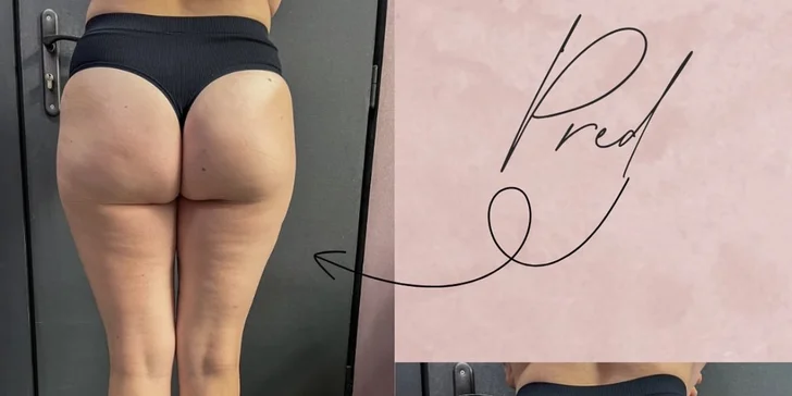 Vákuová terapia tela alebo tváre: spevnenie pleti aj zoštíhlenie a boj proti celulitíde