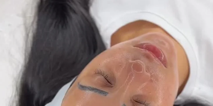 Kozmetické ošetrenia pre čistú a mladistvú pleť: Hollywood Carbon Peel tváre a krku alebo rádiofrekvencia s kompletným čístením pleti