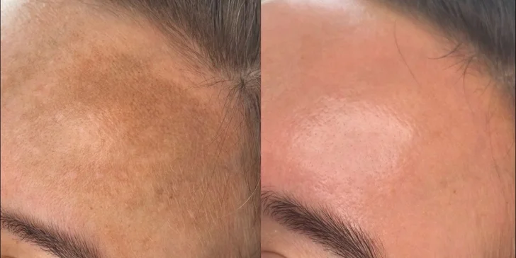 Kozmetické ošetrenia pre čistú a mladistvú pleť: Hollywood Carbon Peel tváre a krku alebo rádiofrekvencia s kompletným čístením pleti