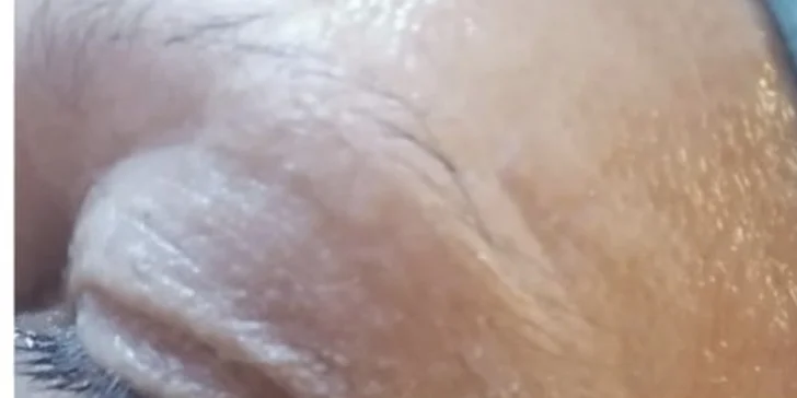 Kozmetické ošetrenia pre čistú a mladistvú pleť: Hollywood Carbon Peel tváre a krku alebo rádiofrekvencia s kompletným čístením pleti