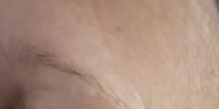 Kozmetické ošetrenia pre čistú a mladistvú pleť: Hollywood Carbon Peel tváre a krku alebo rádiofrekvencia s kompletným čístením pleti