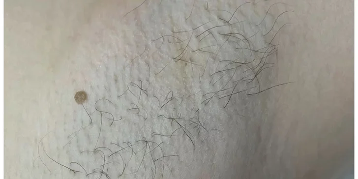 Laserová epilácia - hladká pokožka bez kompromisov