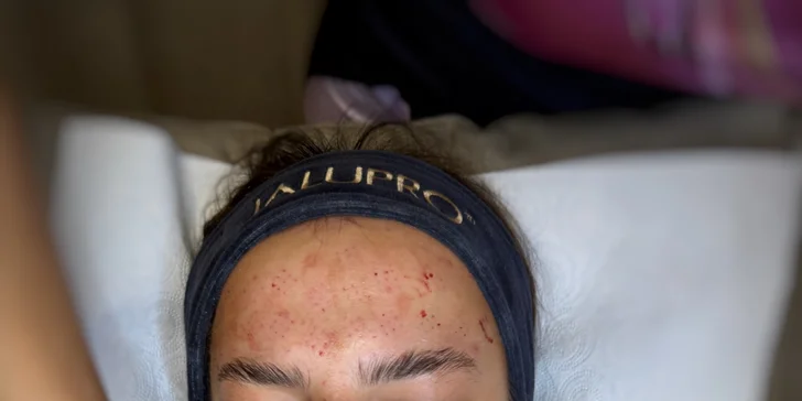 Anti-aging Vital Injector mezoterapia tváre lososou DNA