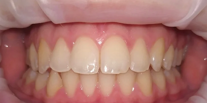 Profesionálne bielenie zubov v ambulancii alebo doma