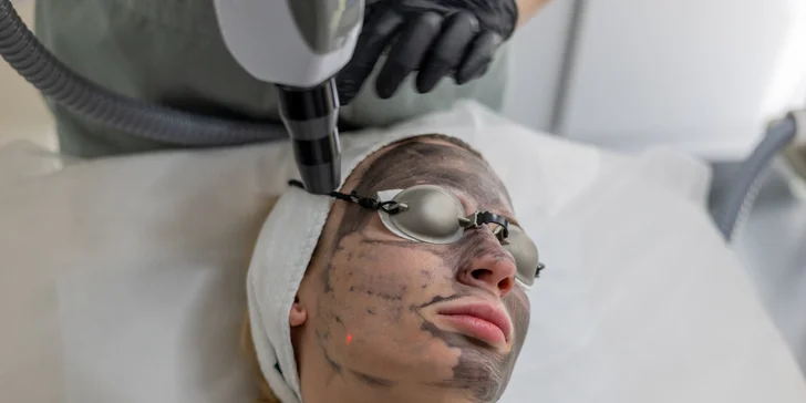 Kozmetické ošetrenia pre čistú a mladistvú pleť: Hollywood Carbon Peel tváre a krku alebo rádiofrekvencia s kompletným čístením pleti