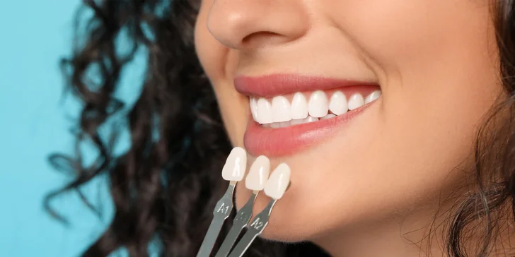 Profesionálne bielenie zubov v ambulancii alebo doma
