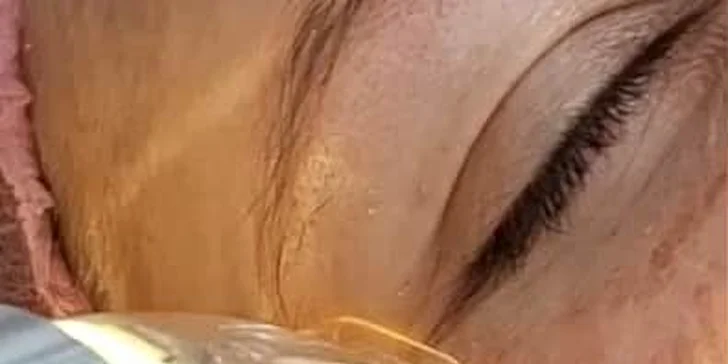 Neinvazívny facelifting pomocou mikroihličkovej frakčnej (MF) rádiofrekvencie: okolie očí, čelo alebo celá tvár