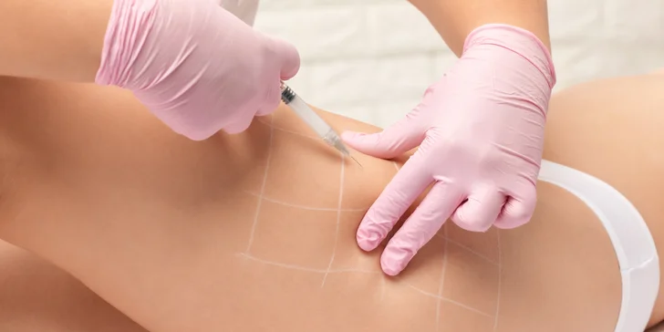 Redukcia tuku v problematických partiách: Injekčná lipolýza podbradku, podpazušia, stehien či brucha