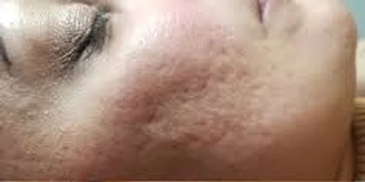 Neinvazívny facelifting pomocou mikroihličkovej frakčnej (MF) rádiofrekvencie: okolie očí, čelo alebo celá tvár