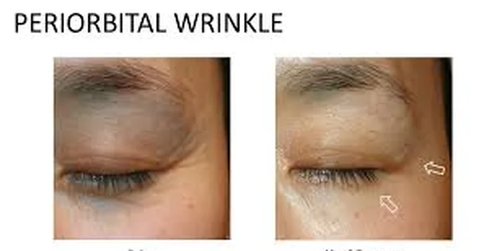 Neinvazívny facelifting pomocou mikroihličkovej frakčnej (MF) rádiofrekvencie: okolie očí, čelo alebo celá tvár