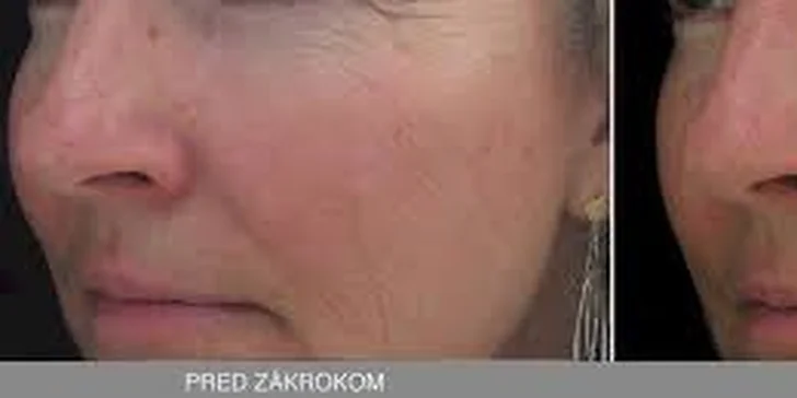 Neinvazívny facelifting pomocou mikroihličkovej frakčnej (MF) rádiofrekvencie: okolie očí, čelo alebo celá tvár