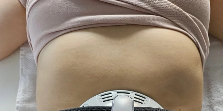 Tvarovanie postavy pomocou kryolipolýzy a EMS