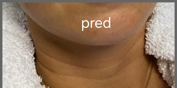 Ošetrenie s exozómami pre rozjasnenú a spevnenú pleť