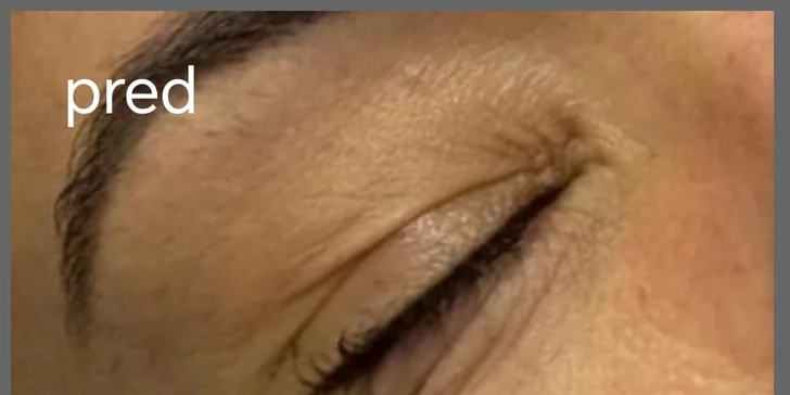 Ošetrenie s exozómami pre rozjasnenú a spevnenú pleť