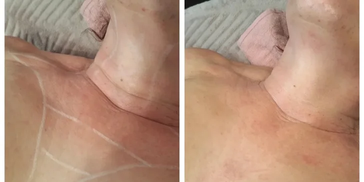 HIFU 12D ošetrenie: spevnená pleť a zvýraznené kontúry tváre