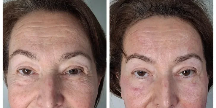 HIFU 12D ošetrenie: spevnená pleť a zvýraznené kontúry tváre