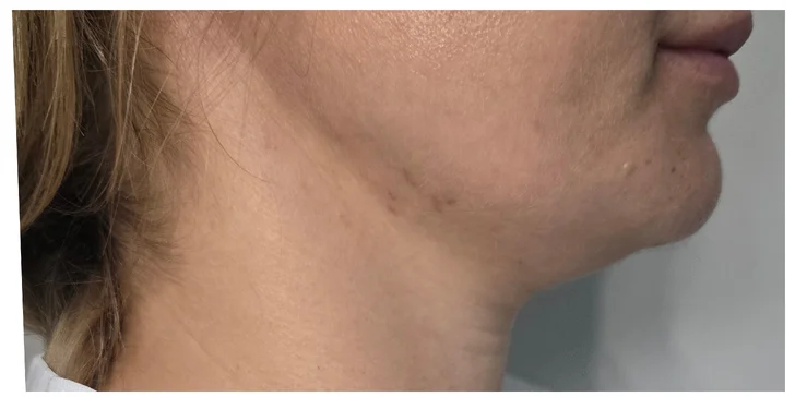 HIFU 12D ošetrenie: spevnená pleť a zvýraznené kontúry tváre