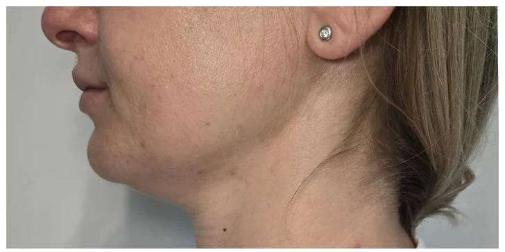 HIFU 12D ošetrenie: spevnená pleť a zvýraznené kontúry tváre