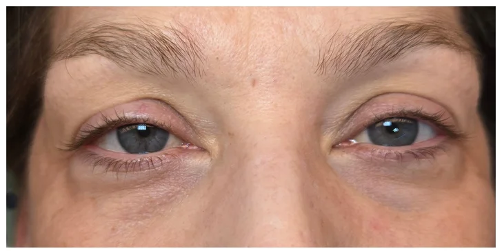 HIFU 12D ošetrenie: spevnená pleť a zvýraznené kontúry tváre