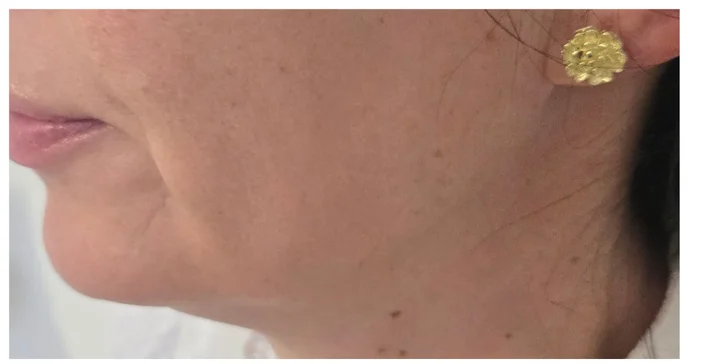 HIFU 12D ošetrenie: spevnená pleť a zvýraznené kontúry tváre