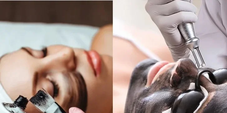 Komplexné ošetrenie HOLLYWOOD CARBON PEEL, aj permanentka na 4 ošetrenia