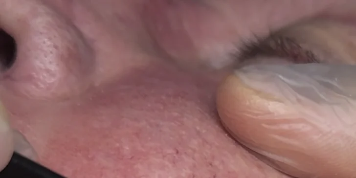 Odstránenie cievnych sietí a metličkových žiliek vysokorádiovou ihlo, RF koagulácia