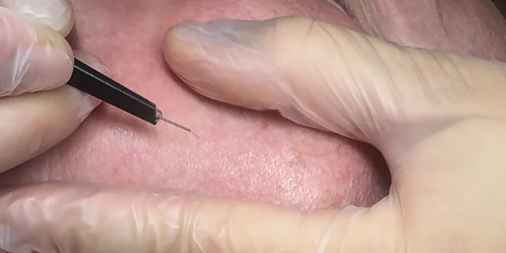 Odstránenie cievnych sietí a metličkových žiliek vysokorádiovou ihlo, RF koagulácia