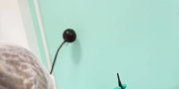 Odstránenie cievnych sietí a metličkových žiliek vysokorádiovou ihlo, RF koagulácia