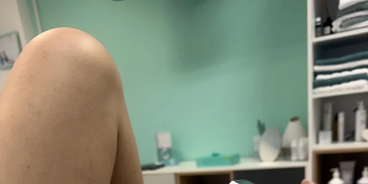 Laserová epilácia diódovým laserom Alfa Pro 2 pre dámy aj pánov