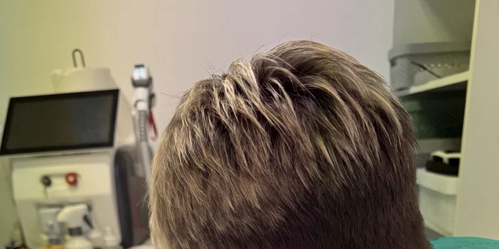 Elektroepilácia: trvalé odstránenie chĺpkov, aj výhodné permanentky